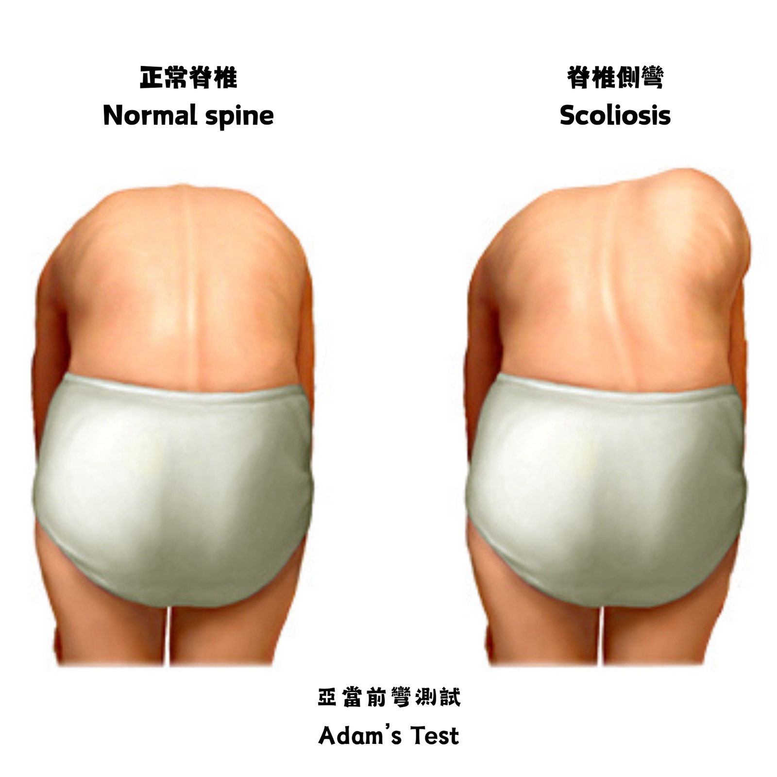 亞當式前彎測試(Adam's Forward Bend Test)