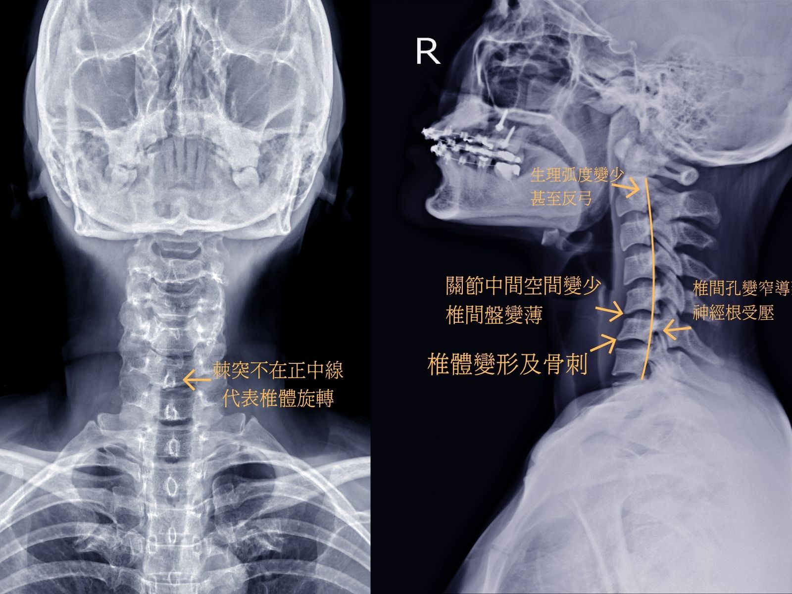 頸椎退化的 X 光標註圖：左為正面片，棘突不在正中線代表椎體旋轉；右為側面片，可見椎間隙變窄、椎體變形及骨刺、椎間孔變窄導致神經根受壓