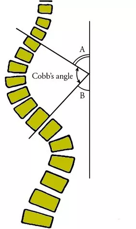 柯布氏角(Cobb Angle)量度示意圖