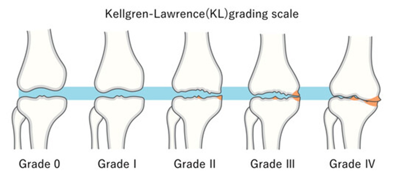 Kellgren-Lawrence 膝關節退化分級圖(Grade 0–4)
