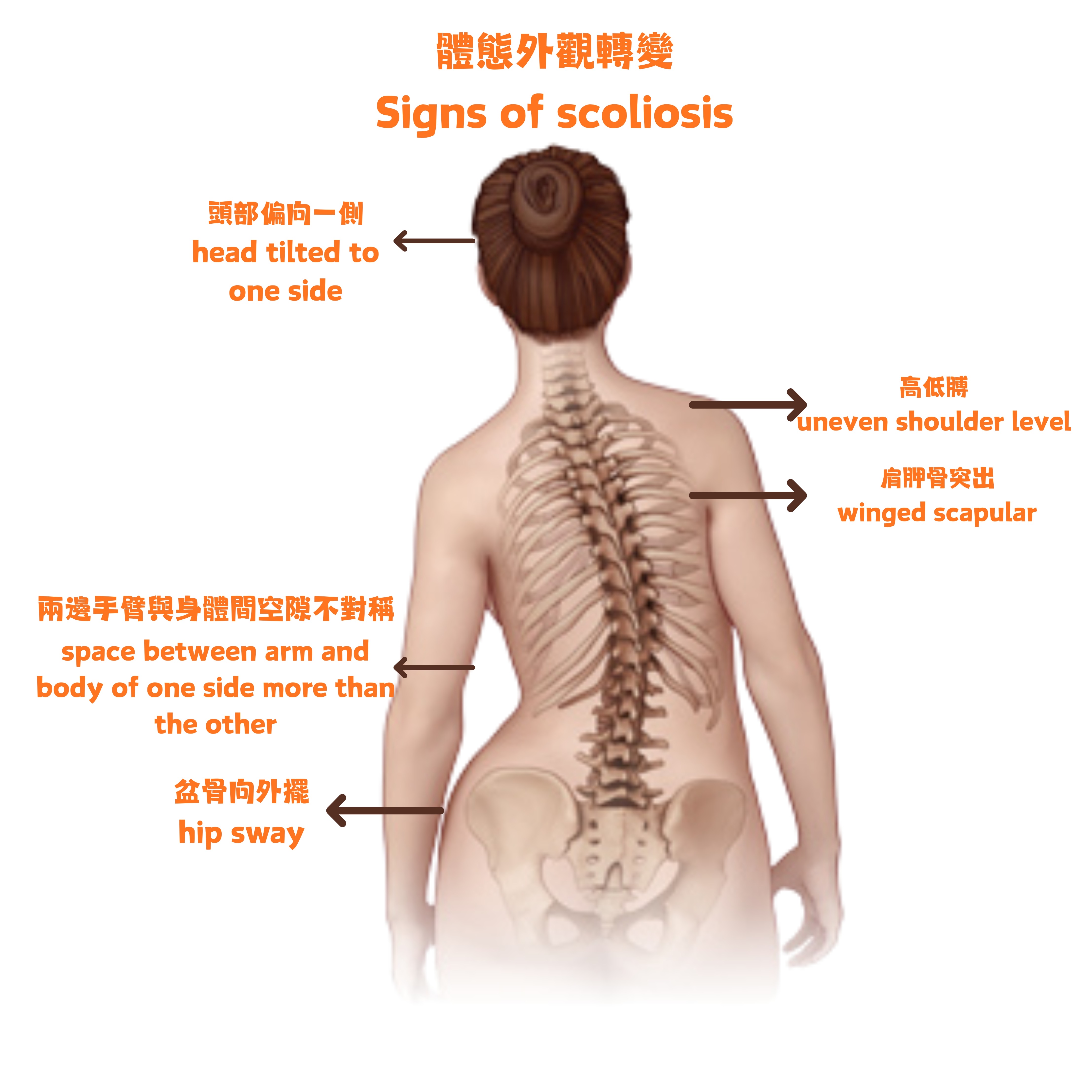 脊柱側彎外觀觀察重點:高低膊、肩胛骨不對稱、腰際線不對稱